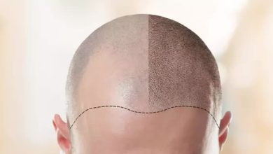 hair transplant