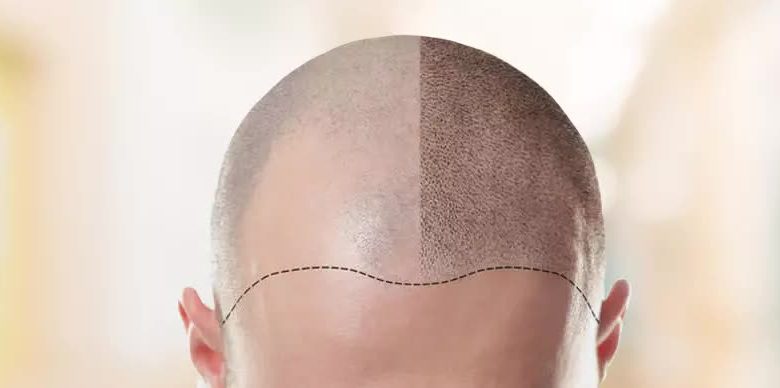 hair transplant