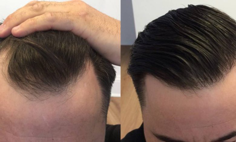 FUE Hair Transplant Near Me