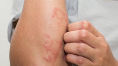 eczema-diseases