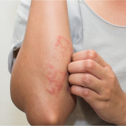 eczema-diseases