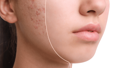 The 10 Best Products to Get Rid of Acne Scars