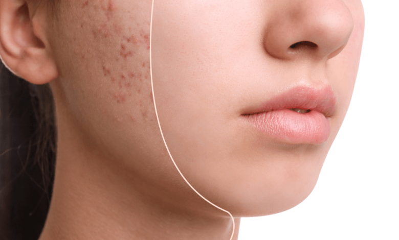 The 10 Best Products to Get Rid of Acne Scars