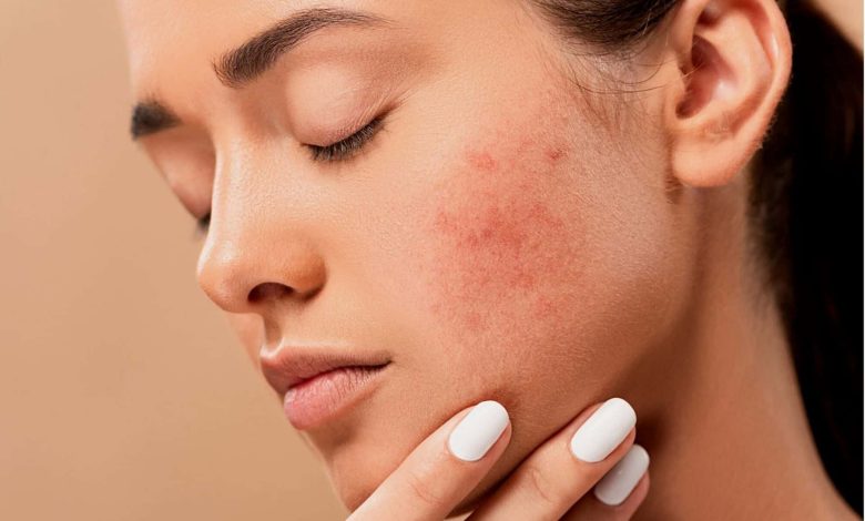 Why does glutathione cause acne breakouts