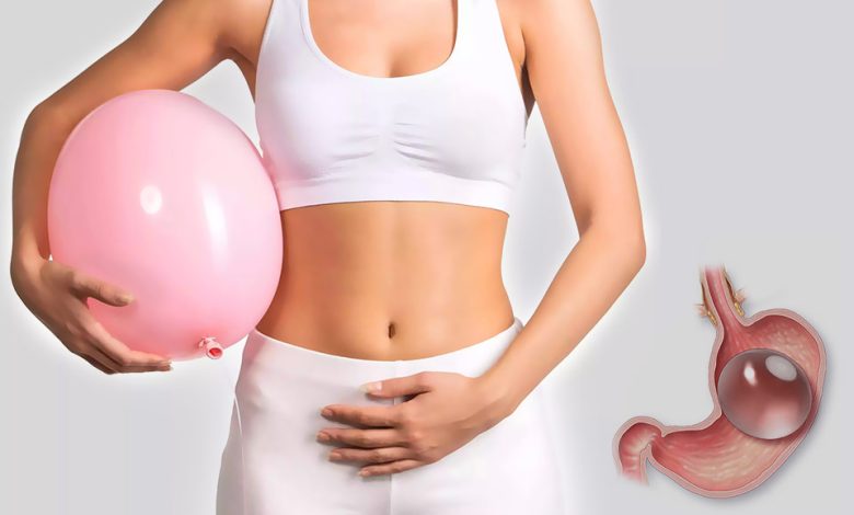 Gastric Balloon in Dubai