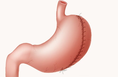 Gastic Plication in Dubai